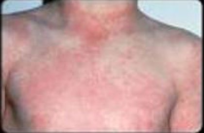 Կարմրախտի մորթային ցան