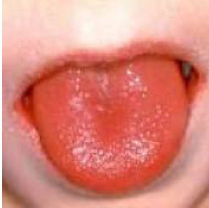 Կարմրախտի ելակալեզու