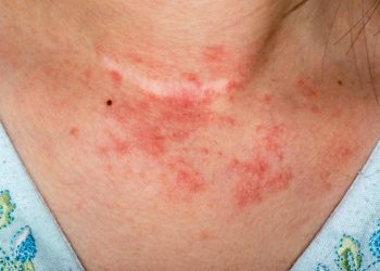 Գետ-Գիտութեան. Որո՞նք Են Էկզեմայի Տարբեր Տեսակները